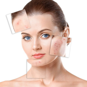 Acne & Skin Care