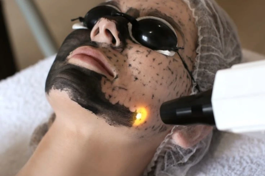 Carbon Laser Treatment