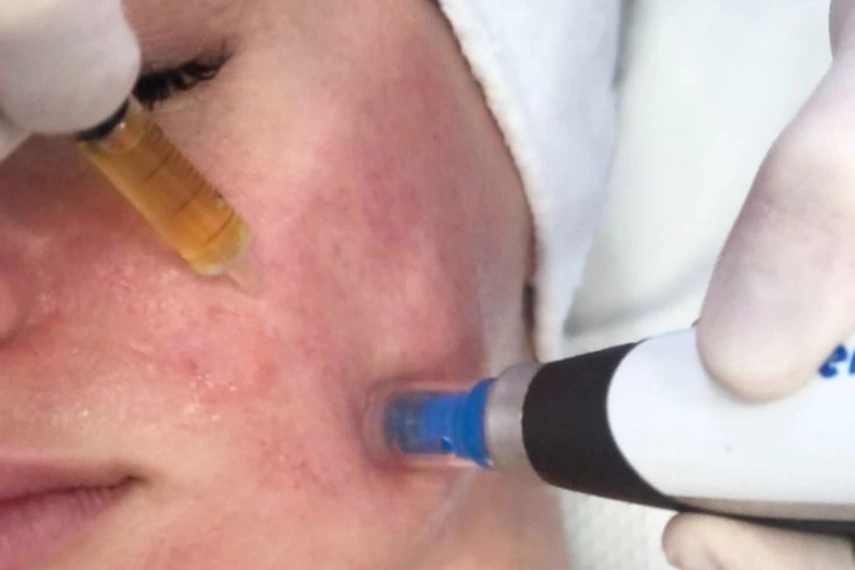 MNRF Treatment